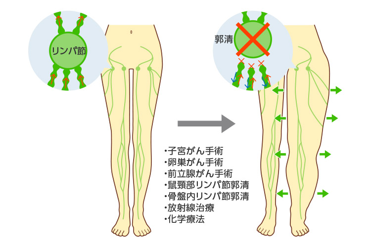 リンパ浮腫の原因のイメージ画像