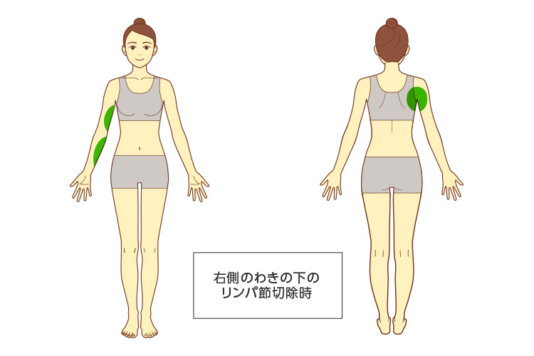 切除に近い部位のイメージ画像