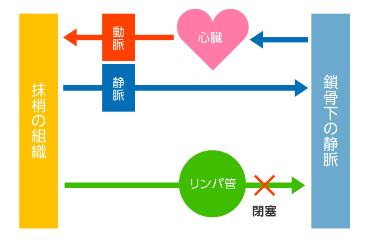 閉塞したリンパ管の図
