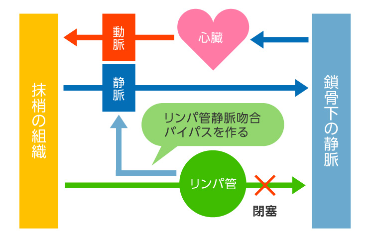 リンパ管から静脈へ「バイパス」を作る図