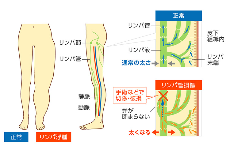 リンパ浮腫の発生の仕組みのイメージ画像