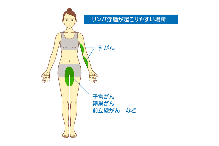 リンパ浮腫の発症しやすい部位（二の腕や背中、太ももや下腹部、外陰部等）の画像
